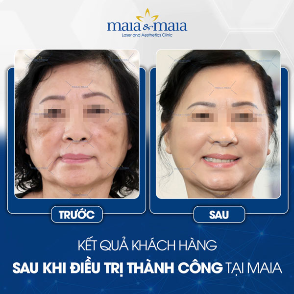 khách trị nám thành công