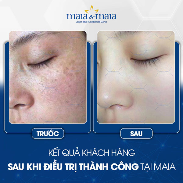 khách trị nám