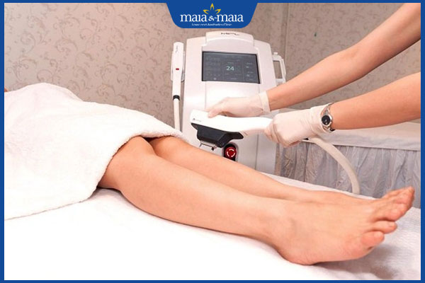 loại bỏ lông bằng laser