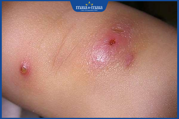mụn đinh râu sưng