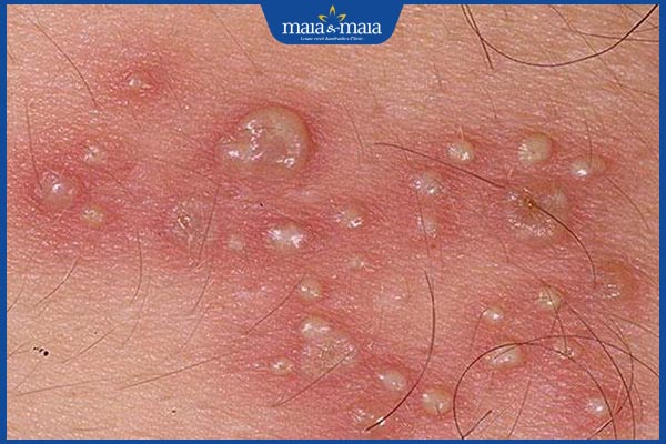 nốt sùi mào gà ở nam giới
