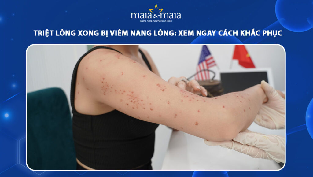 triệt lông xong bị viêm nang lông