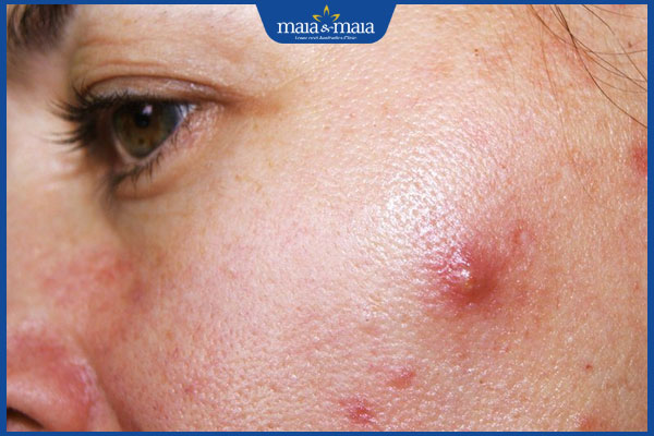 nổi mụn bọc trên má