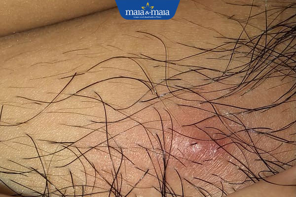 nổi mụn thịt ở vùng kín