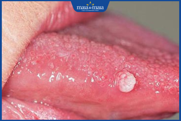 nốt mụn thịt ở lưỡi