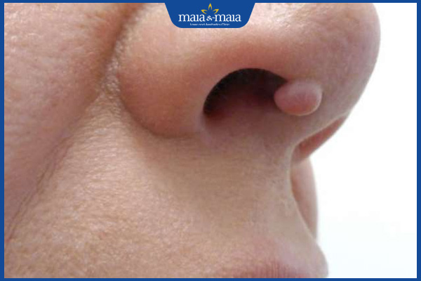 nốt mụn thịt ở mũi