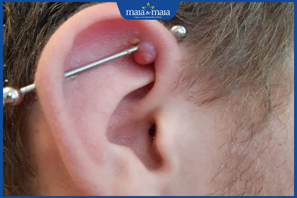 sẹo lồi bấm lỗ tai