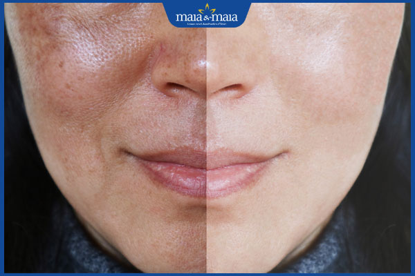 hiệu quả trị nám từ azelaic acid