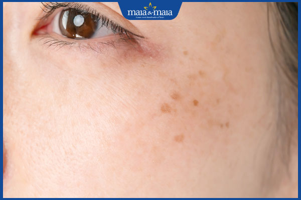 người nên thực hiện laser co2 fractional