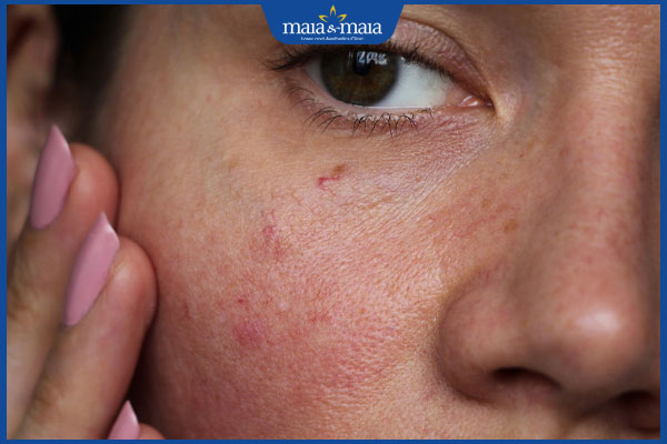 người nên thực hiện laser toning