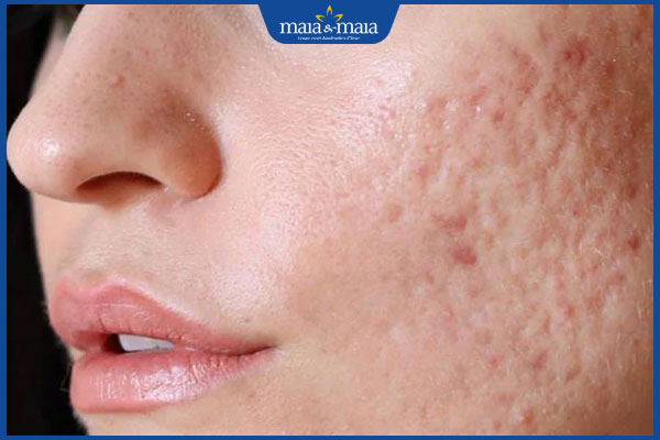 người nên thực hiện phi kim trị sẹo rỗ