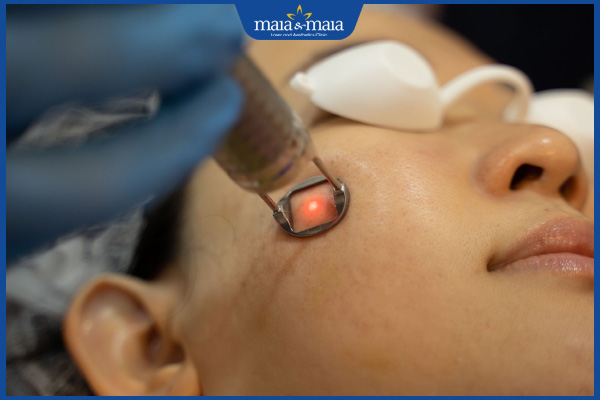 thực hiện trị nám bằng laser picosure