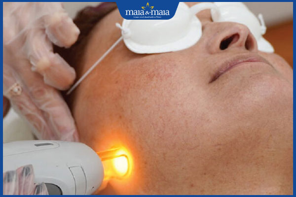 tìm hiểu về laser toning