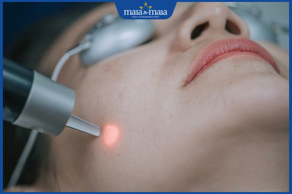 tổng quan về kỹ thuật laser picosure trị nám 
