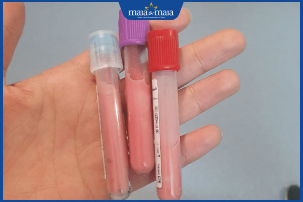 tổng quan về phương pháp prp