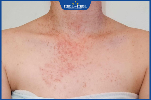 tránh triệt lông nhiều lần 1 tuần