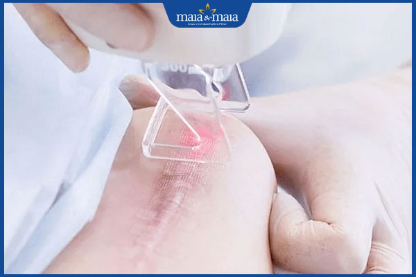 bắn laser trị sẹo bỏng bô