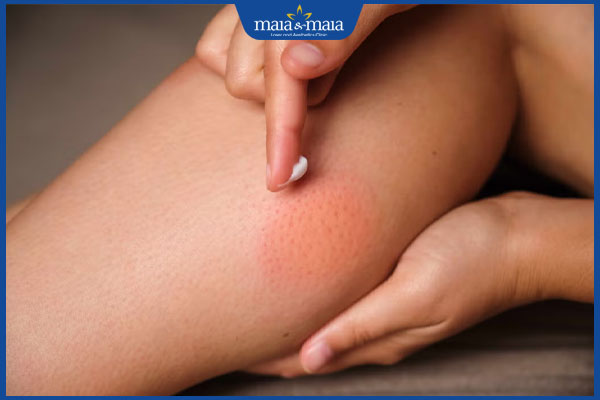 bôi thuốc khi bị kiến ba khoang cắn