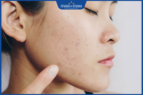 dấu hiệu sẹo thâm mụn