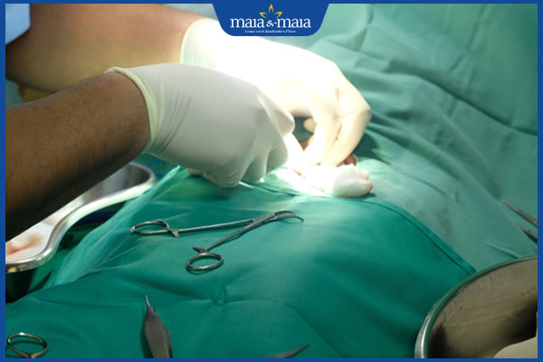 laser trị sẹo bao quy đầu