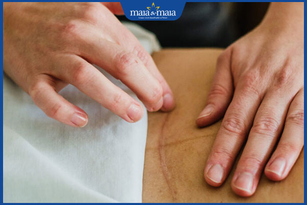 massage sẹo sinh mổ