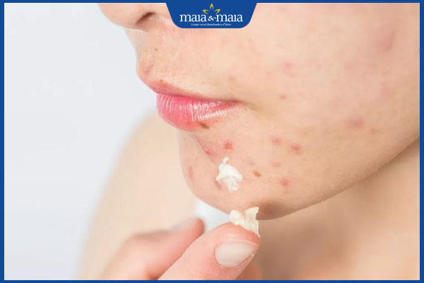 thoa kem trị sẹo thâm mụn