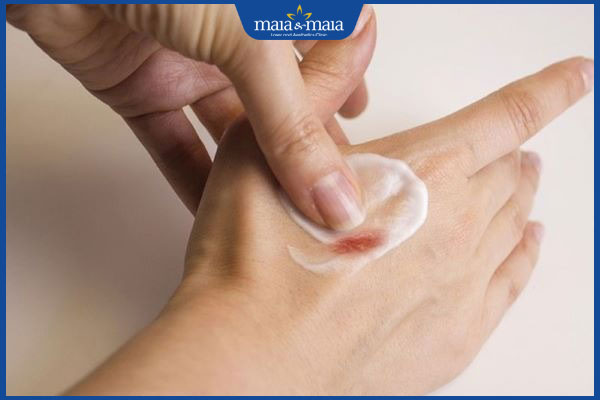 thời điểm nên bôi kem trị sẹo