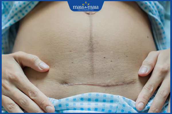 vết sẹo mổ lấy thai