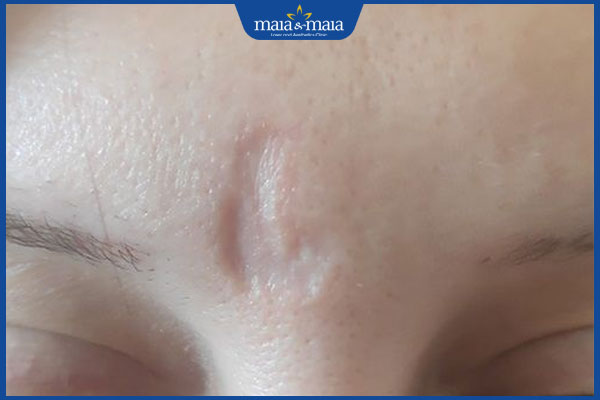 vết sẹo ở ấn đường