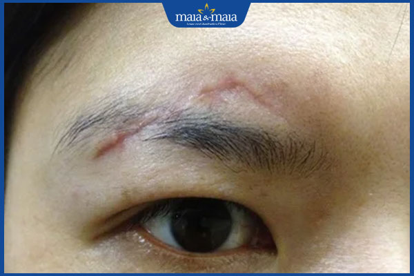 vết sẹo ở lông mày