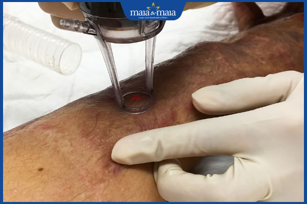 xóa sẹo bỏng bằng laser