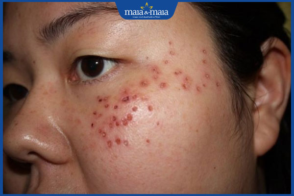 chấm axit xóa tàn nhang