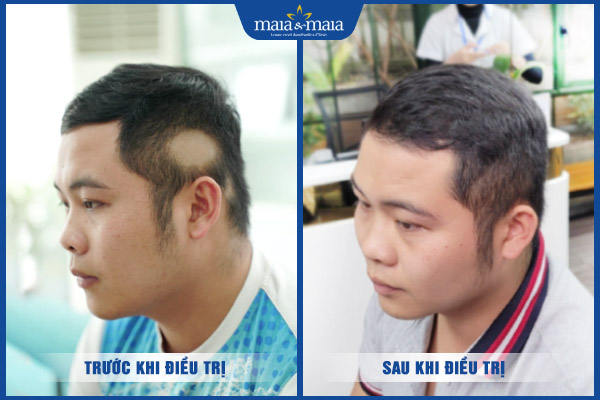 khách trị rụng tóc hói đầu