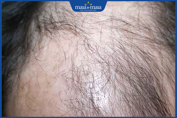 Rụng tóc anagen: Nguyên nhân và cách điều trị hiệu quả 2 kiểu rụng tóc anagen