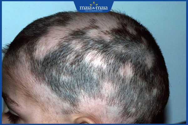 kiểu tóc rụng rừng thưa