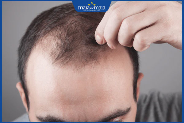 rụng tóc androgen ở nam