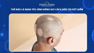 rụng tóc hình đồng xu
