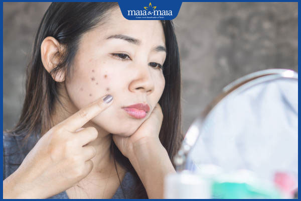thâm sau khi bắn tàn nhang
