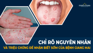 chỉ rõ nguyên nhân và triệu chứng để nhận biết sớm của bệnh giang mai