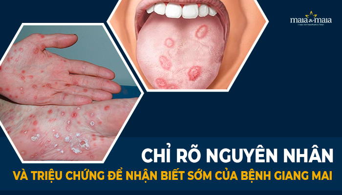 chỉ rõ nguyên nhân và triệu chứng để nhận biết sớm của bệnh giang mai
