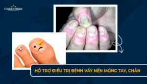 hỗ trợ điều trị bệnh vẩy nến ở móng tay chân