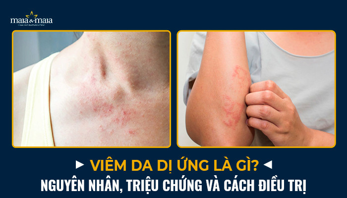 viem da di ung