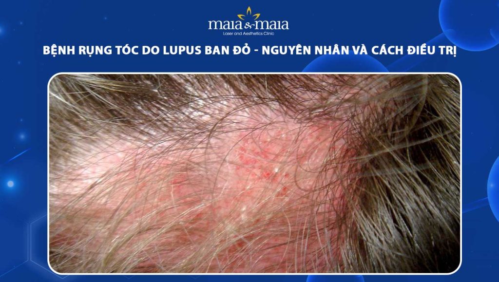 bệnh rụng tóc do lupus ban đỏ nguyên nhân và cách điều trị