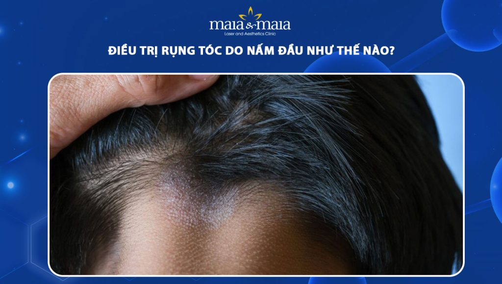 điều trị rụng tóc do nấm da đầu như thế nào
