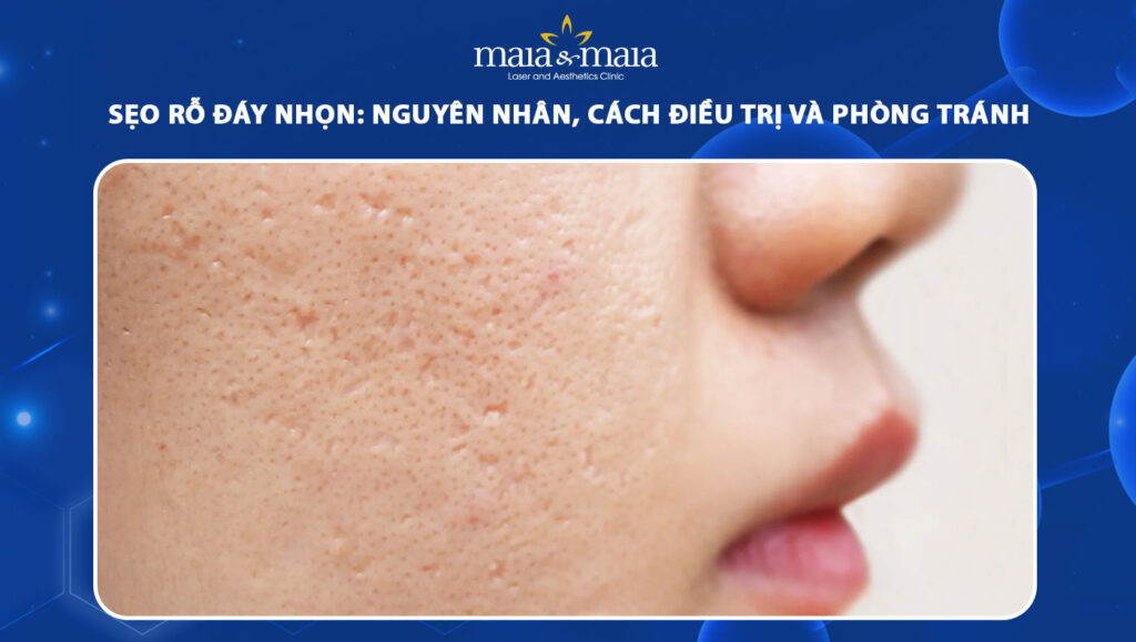 sẹo rỗ đáy nhọn