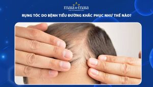 rụng tóc do bệnh tiểu đường khắc phục như thế nào