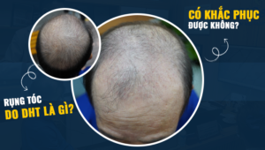rụng tóc do dht