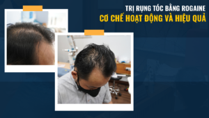 trị rụng tóc bằng rogaine