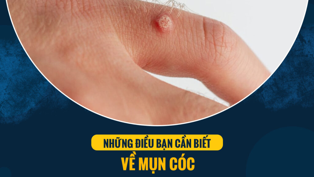 dieu tri mun coc 1