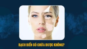 bạch biến có chữa được không
